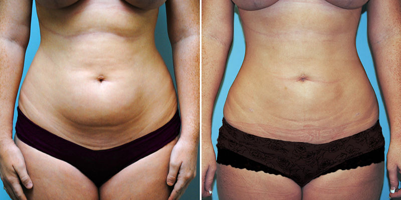 Photo of Fat Loss And Sugar Products by Romy Joseph