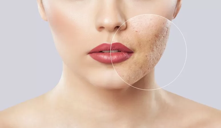 Photo of Erase the Past, Reveal Your Glow: Acne Scar Solutions in Dubai by Hadia Batool