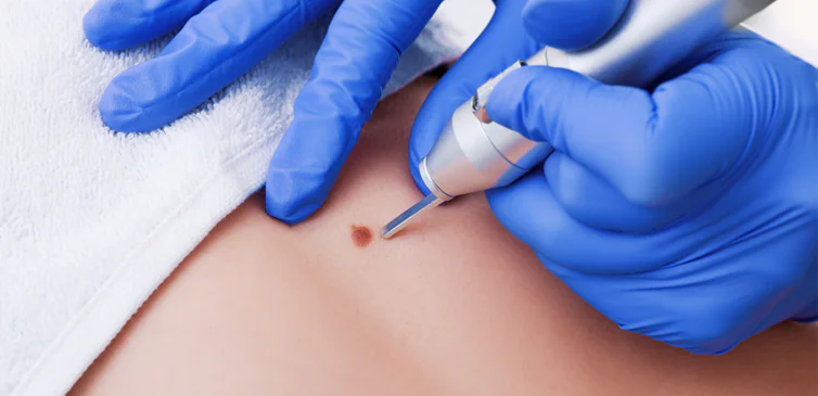 Photo of Dubai's Beauty Revolution: The Rise of Skin Lesion Removal Procedures by Hadia Batool