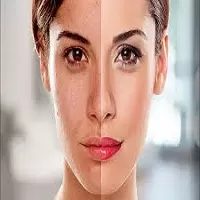 Photo of From Dull to Dazzling: Skin Whitening Treatment Trends in Dubai by Hadia Batool