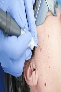 Photo of "Dubai’s Skin Tag Removal Revolution: What’s New in 2024" by Hadia Batool