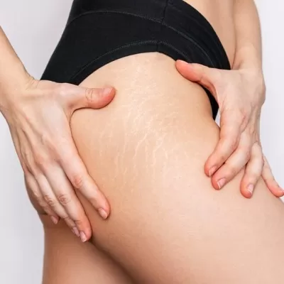 Photo of "Dubai's Dermatologists Spill the Beans: The Best Methods for Stretch Marks Removal!" by Hadia Batool