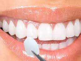 Photo of غيّر ابتسامتك باستخدام قشور الأسنان في دبي by Dynamic Clinic