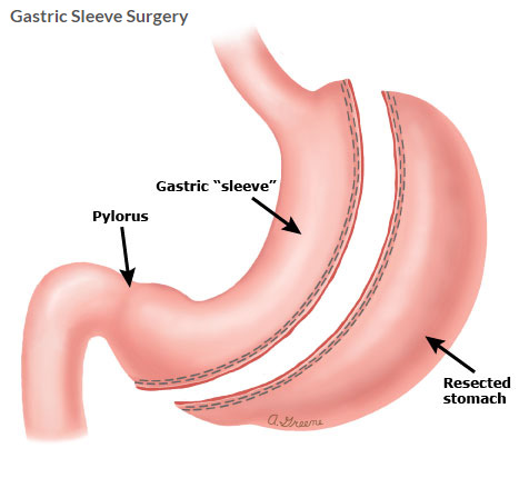 Photo of عملية تكميم المعدة في دبي: غيّر صحتك by Dynamic Clinic