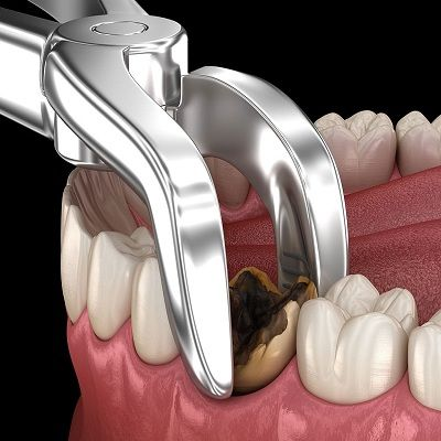 Photo of خلع الأسنان في دبي: حلول سريعة وغير مؤلمة by Dynamic Clinic