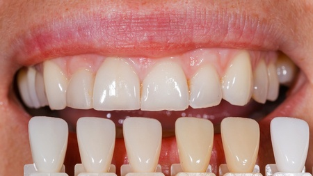 Photo of قشور الأسنان الاحترافية للحصول على ابتسامة مثالية by Dynamic Clinic