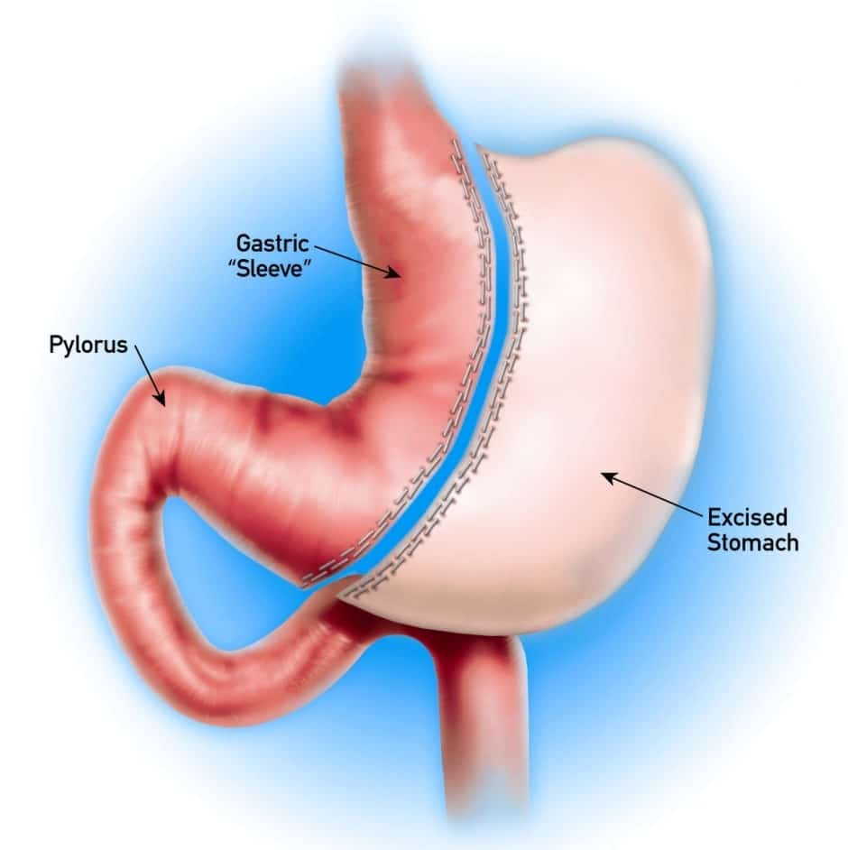 Photo of تكميم المعدة: طريقك إلى فقدان الوزن بشكل دائم by Dynamic Clinic