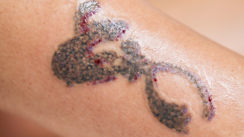 Photo of التعرف على علامات العدوى بعد إزالة الوشم بالليزر by Dynamic Clinic
