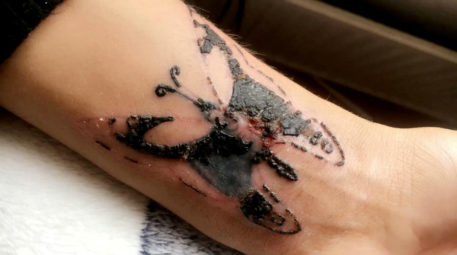 Photo of Recognizing Early Infection Symptoms After Laser Tattoo Removal by Dynamic Clinic