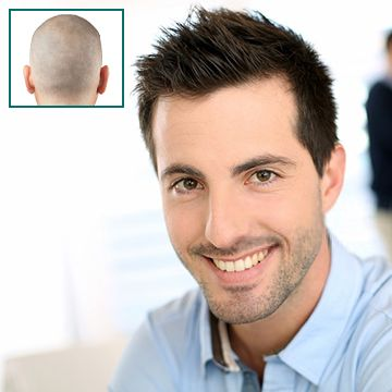 Photo of Why Micro Scalp Pigmentation Is a Game-Changer by Dynamic Clinic