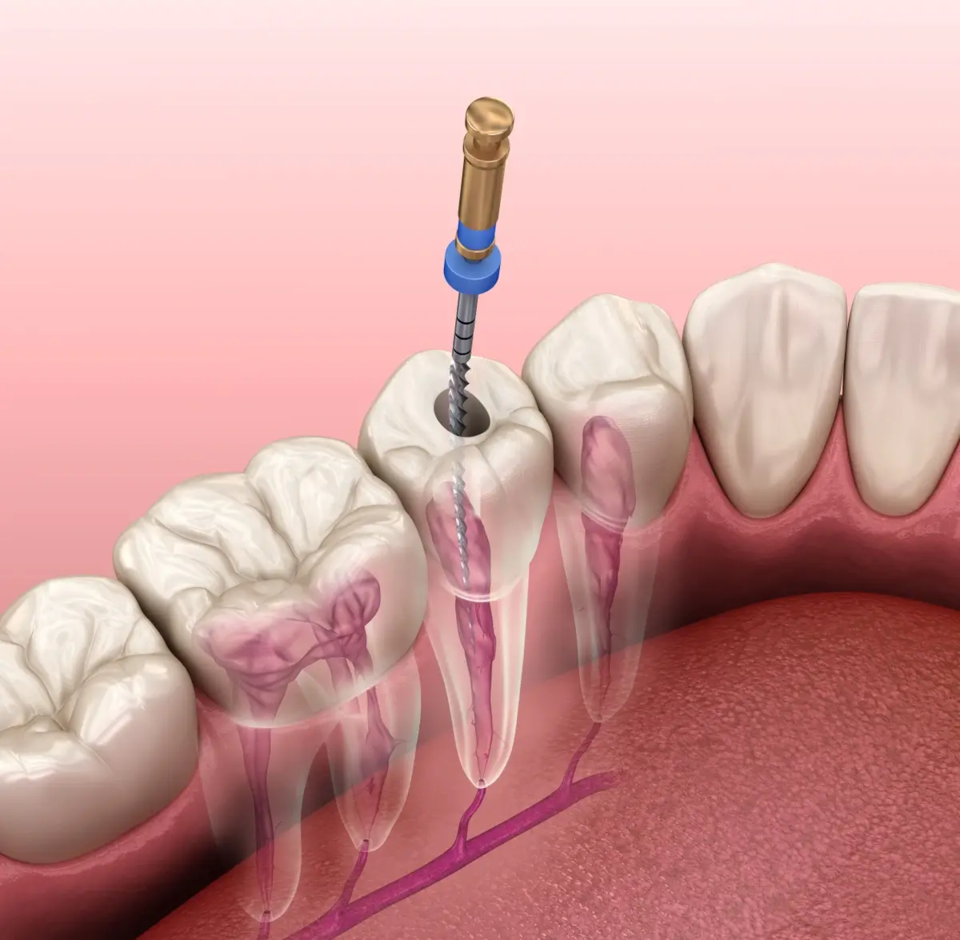 Photo of Signs You Might Need a Root Canal Treatment by Dynamic Clinic