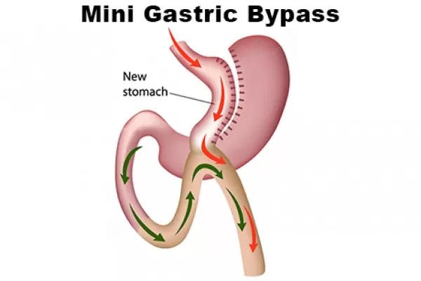 Photo of Top Benefits of Mini Gastric Bypass Surgery by Dynamic Clinic