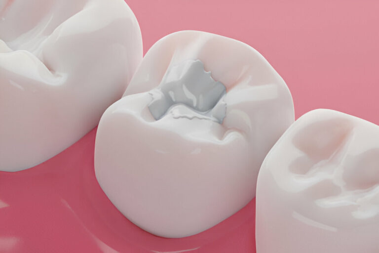 Photo of Do You Need a Dental Filling? Signs and Symptoms by Dynamic Clinic
