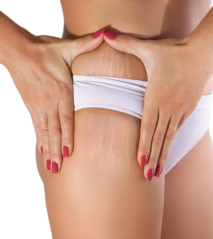 Photo of How Laser Technology Can Help With Stretch Marks by Dynamic Clinic