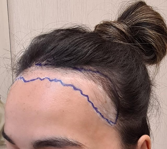 Photo of The Ultimate Guide to Hair Transplants for Women by Dynamic Clinic