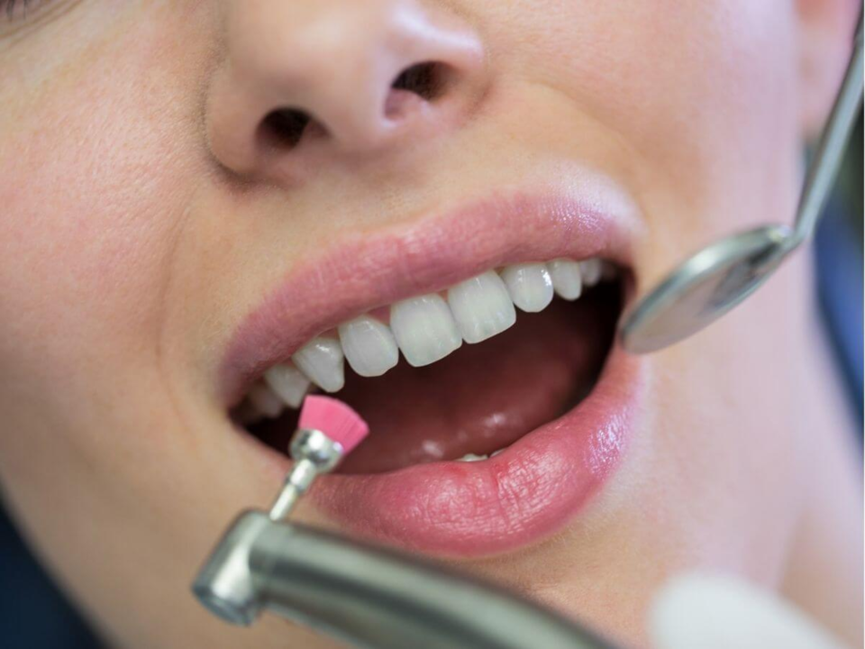 Photo of Is Teeth Polishing & Scaling Safe for Sensitive Teeth? by Dynamic Clinic