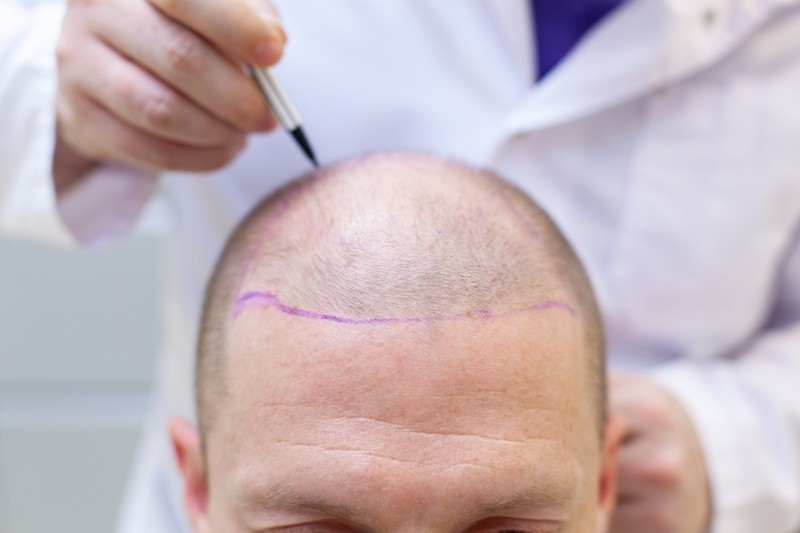 Photo of Is Hair Transplantation Worth the Investment? by Dynamic Clinic