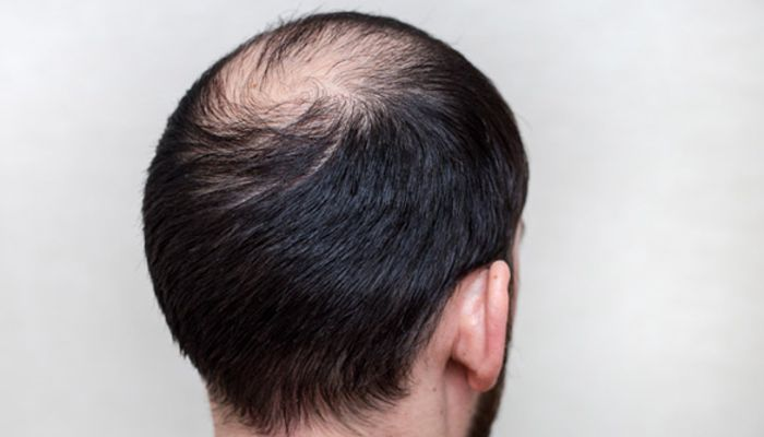 Photo of Everything You Need to Know About Crown Hair Transplants by Dynamic Clinic