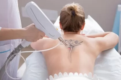 Photo of The Science Behind Laser Tattoo Removal Explained by Dynamic Clinic