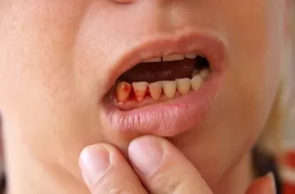 Photo of The Best Solutions for Bleeding Gums: A Comprehensive Guide by Dynamic Clinic