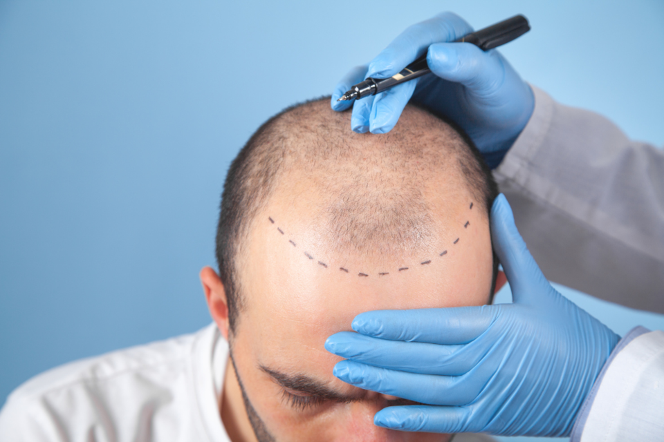 Photo of Is a Hair Transplant Right for You? by Dynamic Clinic