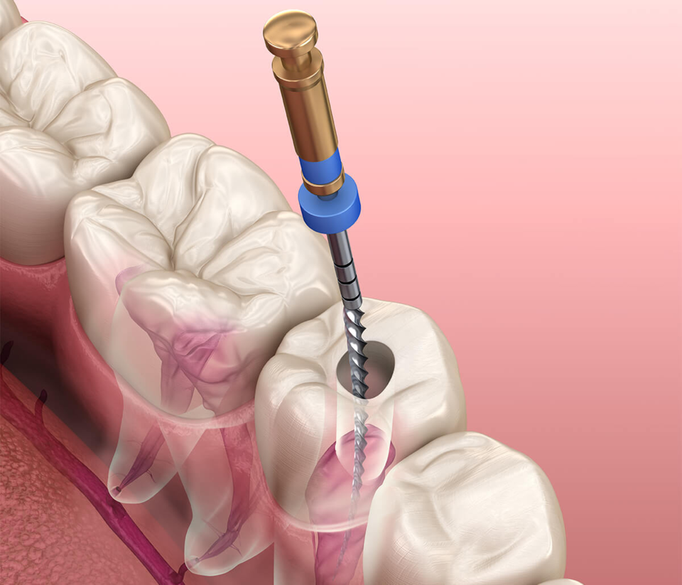 Photo of What Are the Benefits of Root Canal Treatment? by Dynamic Clinic