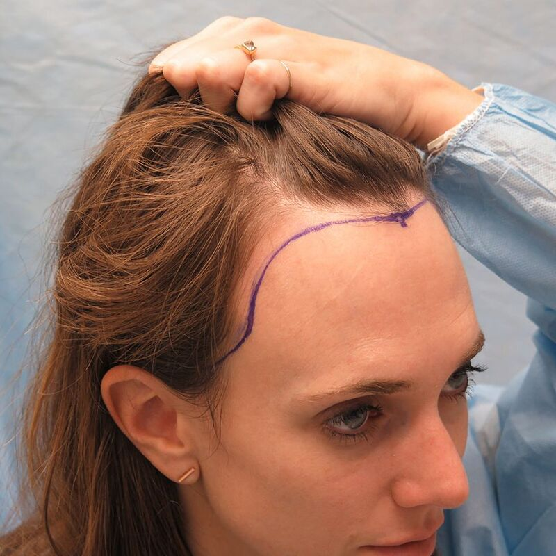 Photo of What Are the Benefits of Hair Transplant for Women? by Dynamic Clinic
