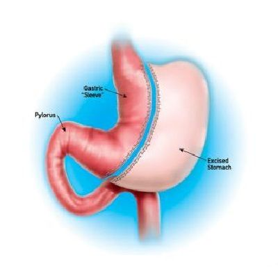 Photo of How Does Gastric Sleeve Impact Weight Loss Journey? by Dynamic Clinic