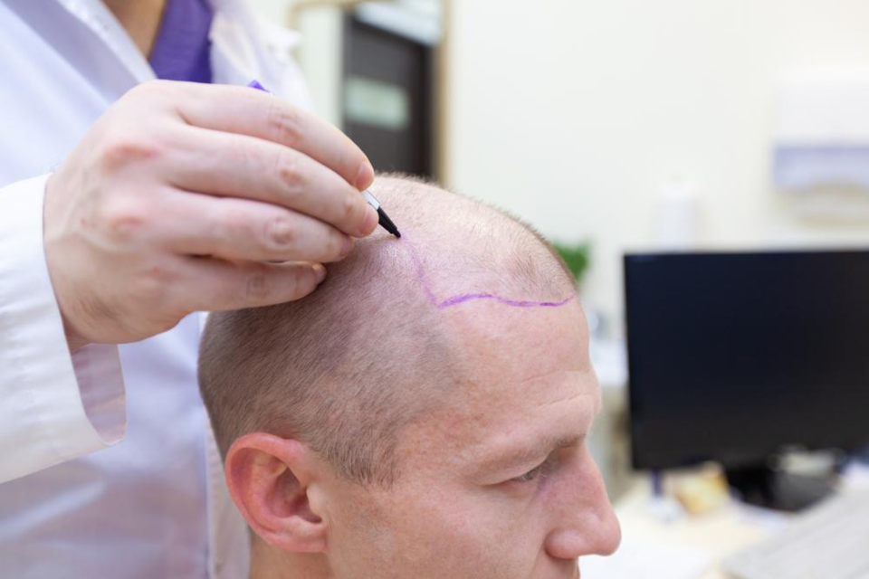 Photo of Is FUE Hair Transplant the Best Choice for You? by Dynamic Clinic