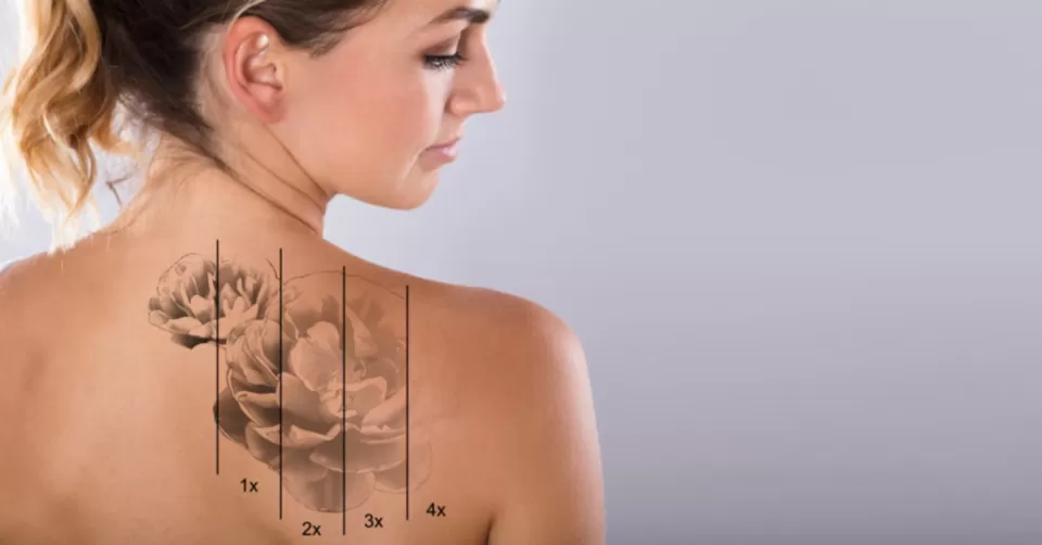 Photo of How Long Do Rejuvi Tattoo Removal Side Effects Last? by Dynamic Clinic